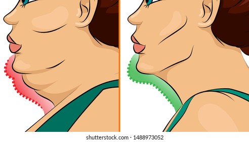 Comparison Of Female Double Chin 
