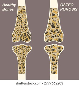 Comparison of Healthy Bone and Osteoporosis Bone Structure Illustration