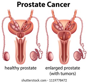 Comparison of Healthy and Cancer Prostate illustration