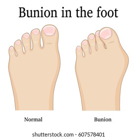 Comparison of a healthy foot and foot with hallux valgus deformity (Bunion)