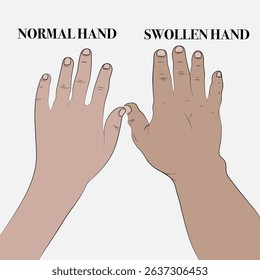 Comparison of healthy hand and hand swollen by fluid accumulation.