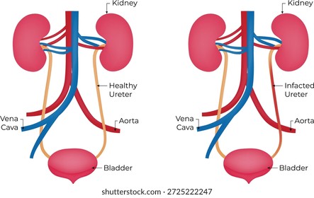 Comparison of Healthy and Infected Urinary System with Ureter Infection