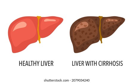 Comparison of healthy liver and liver cirrhosis disease. Human liver organ anatomy vector illustration on white background.