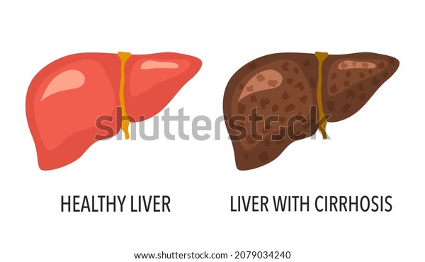 Comparison Healthy Liver Liver Cirrhosis Disease Stock Vector (Royalty ...