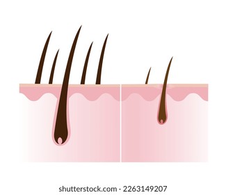 Comparison of healthy and losing hair with scalp layer vector isolated on white background. Hair density, loss, alopecia, baldness and hairless. Hair anatomy concept illustration. 