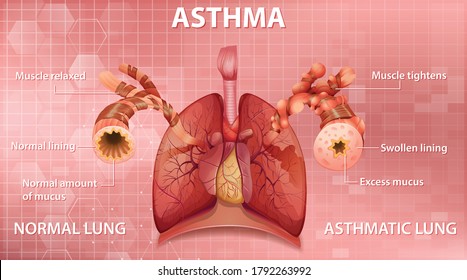 Comparison of healthy lung and Asthmatic lung illustration