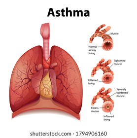 Comparison of healthy lung and Asthmatic lung illustration