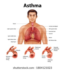 Comparison of healthy lung and Asthmatic lung illustration