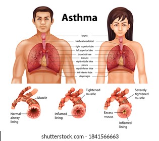 Comparison of healthy lung and Asthmatic lung illustration