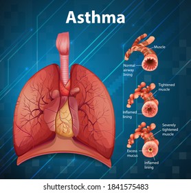 Comparison of healthy lung and Asthmatic lung illustration