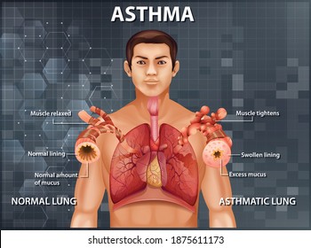 Comparison of healthy lung and Asthmatic lung illustration