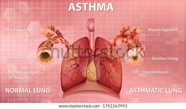 Comparison of healthy lung and Asthmatic\
lung illustration