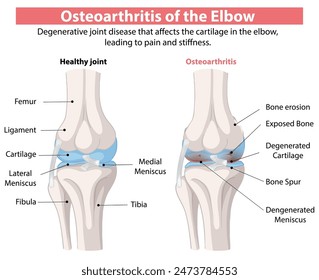 Comparison of healthy and osteoarthritic elbow joints