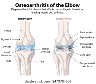Comparison of healthy and osteoarthritic elbow joints