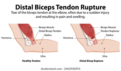 Comparison of healthy and ruptured biceps tendon