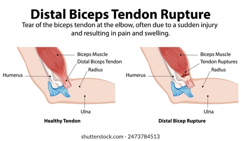 Comparison of healthy tendon and ruptured tendon