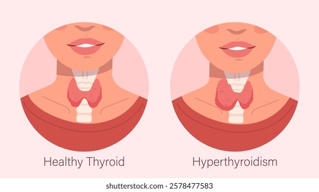 Comparison of a healthy thyroid and hyperthyroidism condition in a female neck, depicted in a minimalistic medical style, on a soft pink background. Concept of thyroid health. Vector illustration