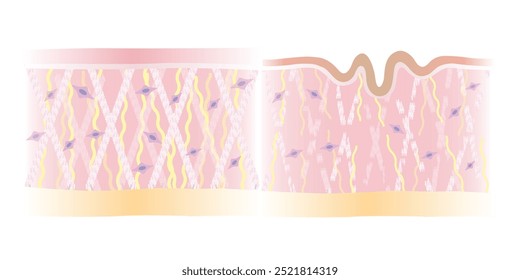 Comparação de estrutura saudável e rugosa da ilustração do vetor da camada da pele isolada no fundo branco. Seção transversal de colagênio intacto e quebrado, fibras de elastina, fibroblastos. Cuidado com a pele e beleza.