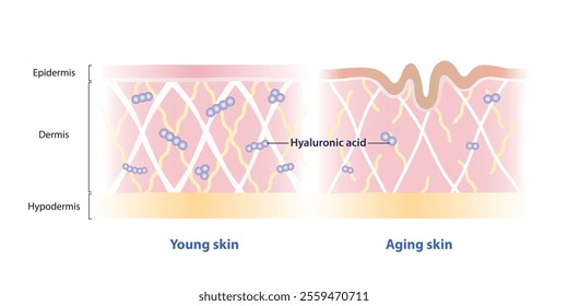 Comparison of Hyaluronic acid levels decrease with age in dermis vector illustration. Cross section of young and aging skin with hyaluronic acid molecule. Skin care and beauty concept.