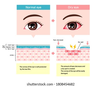 Comparison Illustration Between Normal And Dry Eye. Cross Section Of Eye Surface.