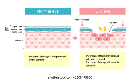 Comparison Illustration Between Normal And Dry Eye. Cross Section Of Eye Surface.