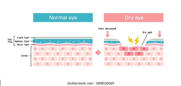 Comparison Illustration Between Normal And Dry Eye. Cross Section Of Eye Surface.