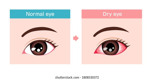 Comparison illustration between normal and dry eye. 