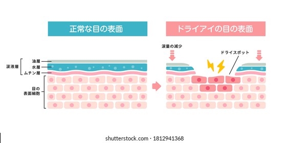 Comparison Illustration Between Normal And Dry Eye. Cross Section Of Eye Surface. Translation: Normal Eye,Dry Eye,Tear Film, Lipid Layer, Aqueous Layer, Mucin Layer, Cornea, Tears Decreased, Dry Spot.