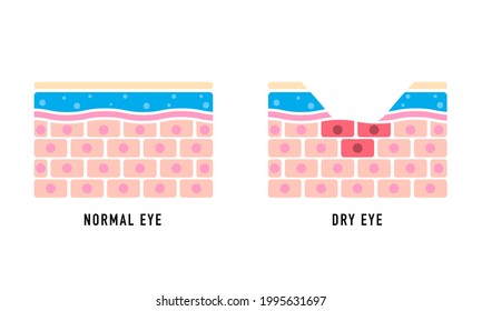 Comparison illustration between normal and dry eye. Cross section of eye surface.