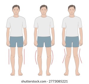 Comparison illustration of bowlegs, knock knees, and normal legs.