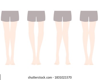 Comparison illustration of distortion of O-leg and X-leg