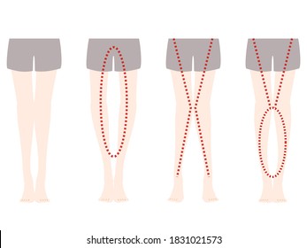 Comparison illustration of distortion of O-leg and X-leg
