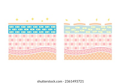 Comparison illustration of healthy skin and dry skin (cross section of skin)