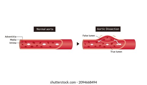 Comparison Illustration Of Normal Aorta And Aortic Dissection 