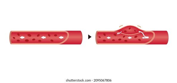 Comparison Illustration Of Normal Aorta And Aortic Dissection (no Text)