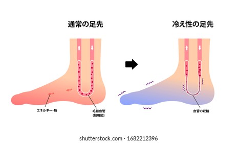 Comparison illustration of normal foot and cold foot ( sensitivity to cold, cold toes) / Japanese. Translation: Normal foot, Cold foot, Energy, Capillaries, Vasoconstriction