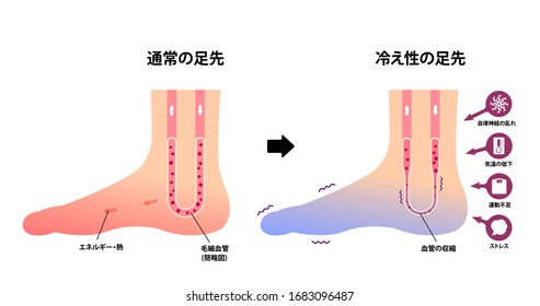 通常の足と寒い足の比較イラスト 寒い足と寒い足の指に対する感度 のベクター画像素材 ロイヤリティフリー