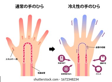 Vergleichs-Illustration von normaler Hand und kalter Hand ( Empfindlichkeit gegen Kälte, kalte Fingerspitzen) / Japanisch. Übersetzung: Normale Hand, kalte Hand, Energie, Kapillare, Vasokonstriktion, Niedrige Temperatur usw.