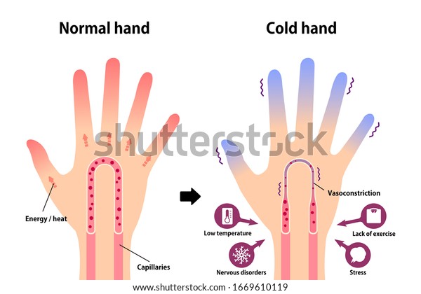 Comparison illustration of normal hand\
and cold hand ( sensitivity to cold, cold fingertips)\
