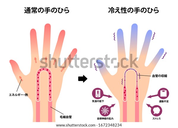 普通の手と冷たい手 指先の冷たさに対する感受性 の比較イラスト 日本語 翻訳 正常手 冷手 エネルギー 毛細血管 血管収縮 低温など のベクター画像素材 ロイヤリティフリー