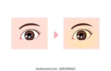 Comparison illustration of normal and jaundiced eyes