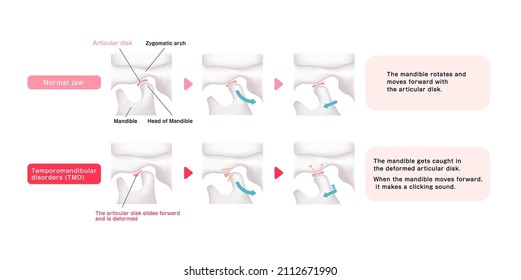 Comparison illustration of normal jaw and Temporomandibular disorders (TMD)