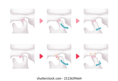 Comparison illustration of normal jaw and Temporomandibular disorders (TMD)