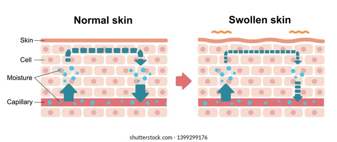 Comparison Illustration Normal Skin Swollen Skin Stock Vector (Royalty ...