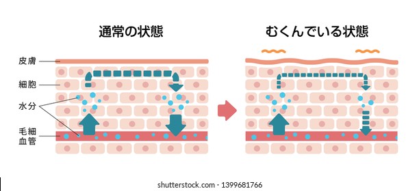 Comparison illustration of normal skin and swollen skin (Japanese / with explanation text). translation: Normal skin, Swollen skin, Cell, Moisture, Capillary.
