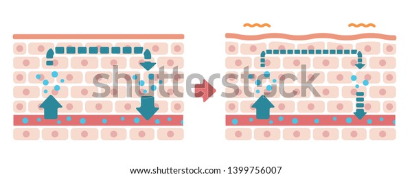 Comparison Illustration Normal Skin Swollen Skin Stock Vector (royalty 