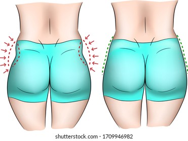 Comparison Of Love Handles On A Woman Body