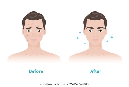 Comparison of man face before and after acne pimple treatment vector illustration. Skin problems in men include inflammatory acne, blackhead, whitehead, papule, pustule, scar. Men skin care concept.