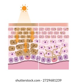 Mecanismo de comparación de hiperpigmentación e ilustración de pigmentación normal. Sección transversal de la hiperpigmentación cuando la piel está expuesta a los rayos UV, la melanina se produce en exceso causando melasma, manchas oscuras.