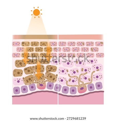 Comparison mechanism of hyperpigmentation and normal pigmentation illustration. Cross section of hyperpigmentation when the skin is exposed to UV rays, the melanin is overproduced causing melasma, dark spots.